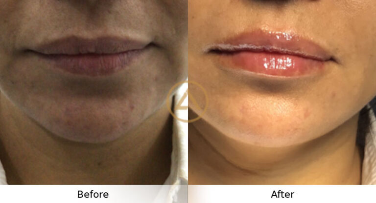 dermal fillers