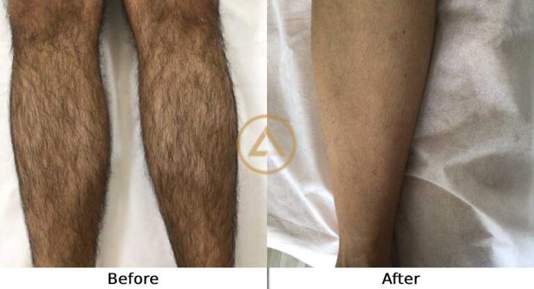 laser hair removal